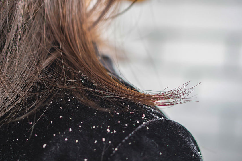 What's The Difference Between Dry Scalp Flakes vs. Dandruff?