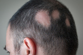 How Do I Know What Type of Alopecia I Have?